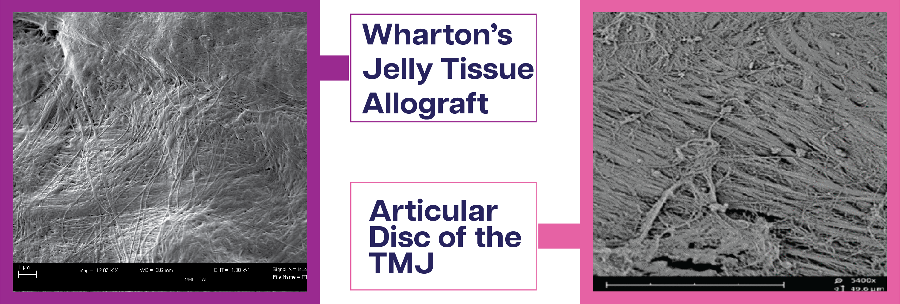 Wharton's Jelly Tissue Allograft - Articular Disc of the TMJ